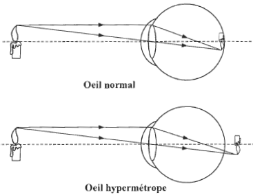 hypermétrope